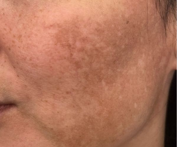 Melasma facial discount