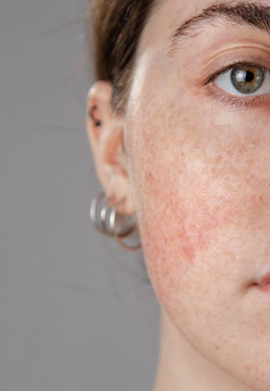 Rosacea Facial