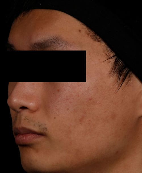 AviClear acne treatment after