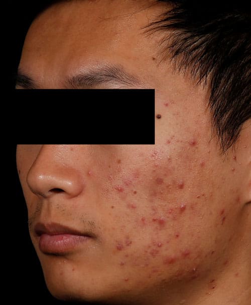 AviClear acne treatment before