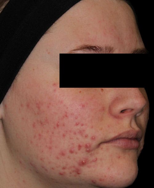 AviClear acne treatment before