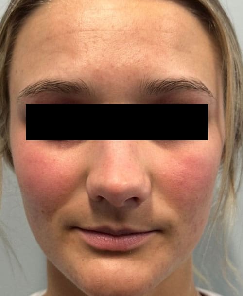 AviClear acne treatment after